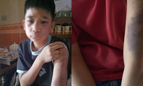 Cháu H. bị bố đẻ và mẹ kế bạo hành thâm tím khắp người.