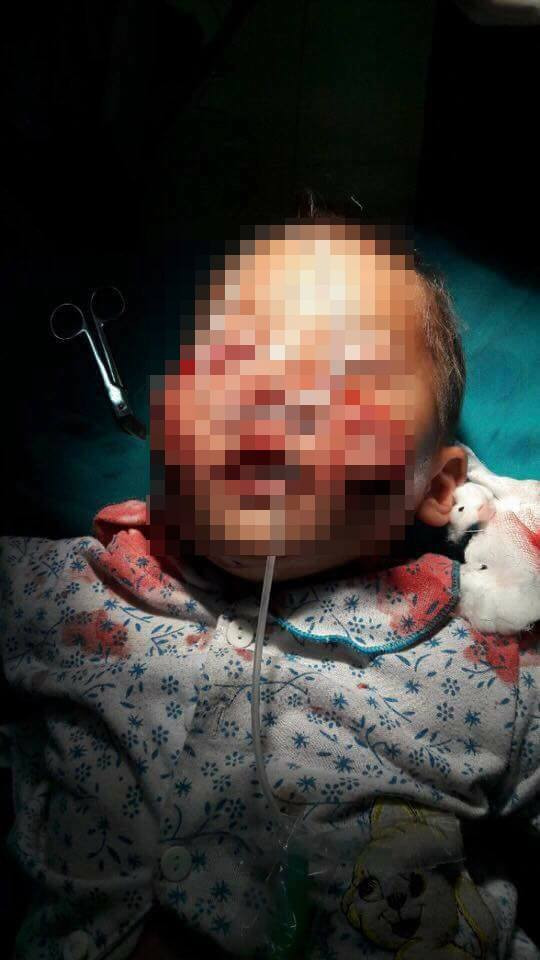 Cháu Trường vẫn đang được các bác sĩ điều trị tích cực.