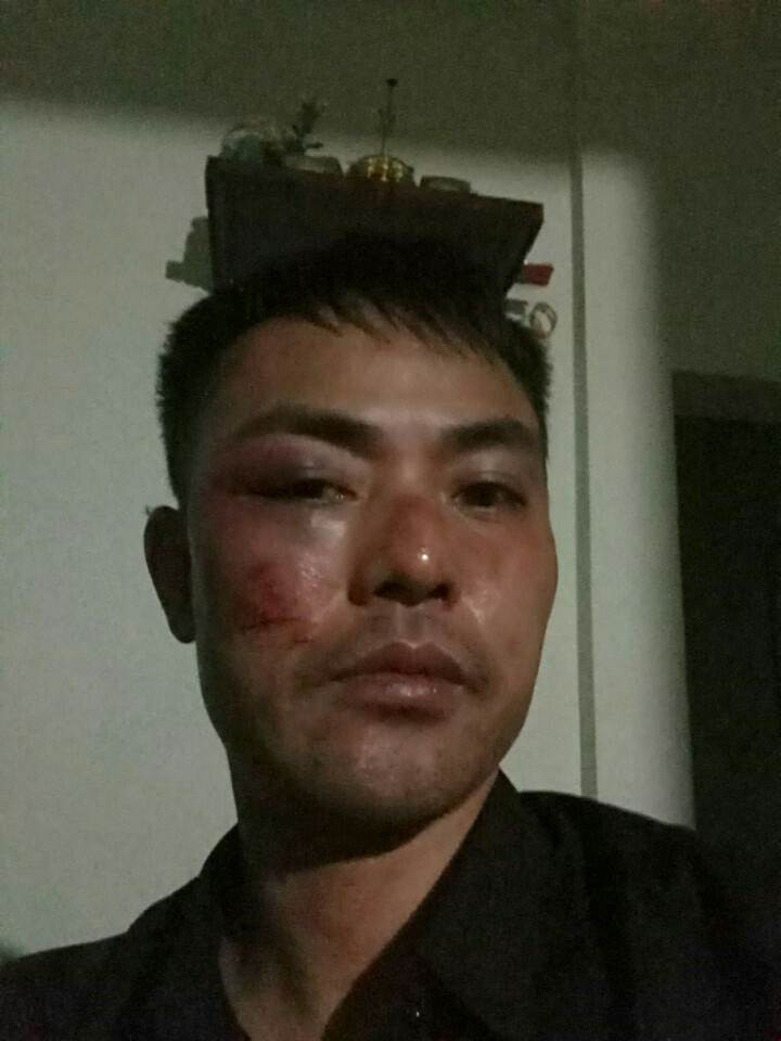 Khuôn mặt của anh Tiến trước đó bị nhóm đối tượng đánh đập.