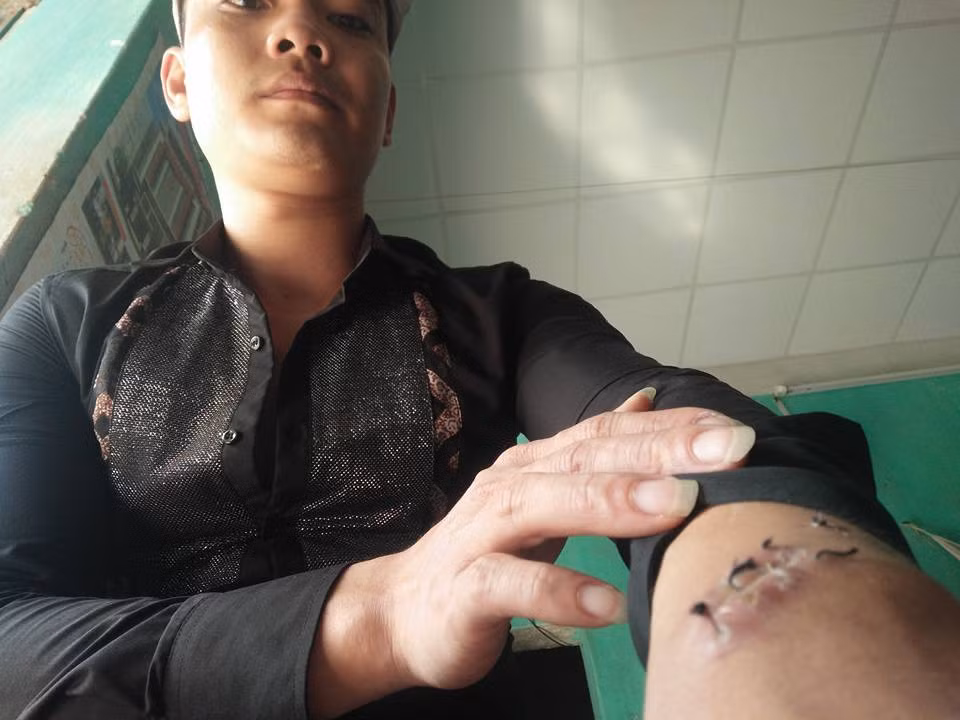 Tay anh Hiệp bị nhóm đối tượng chém, phải khâu 5 mũi.