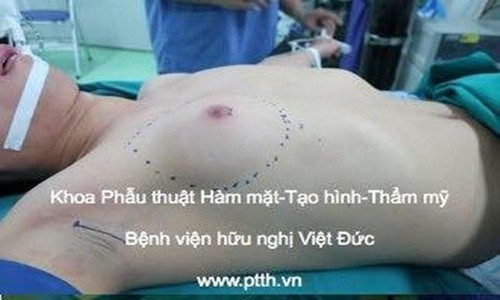 Vú bên ngực phải của bệnh nhân nam phát triển to như ngực phụ nữ trưởng thành.