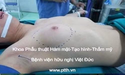 Vú bên ngực phải của bệnh nhân nam phát triển to như ngực phụ nữ trưởng thành.
