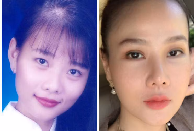 Cựu người mẫu cho biết, mũi của cô đầu mũi to, sóng mũi quá cao so với gương mặt nên cô quyết định sửa mũi S-line cùng với lấy bọng mí mắt dưới. Ảnh: FBNV