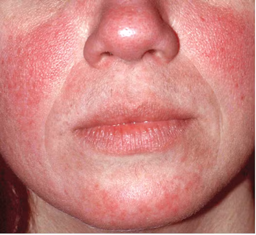 Ký sinh trùng Demodex có thể gây ra chứng bệnh trứng cá đỏ rất khó chịu ở một số người có hạn chế về hệ miễn dịch. (Nguồn Boredom Therapy)