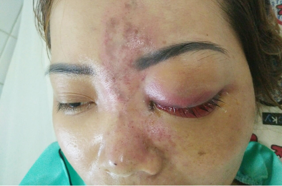 Nữ bệnh nhân bị mù mắt sau 5 phút tiêm filler