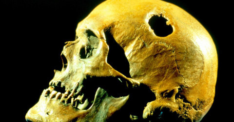 Do trình độ y học thời đó chưa phát triển nên đa số bệnh nhân được điều trị theo phương pháp trên tử vong trong quá trình phẫu thuật.