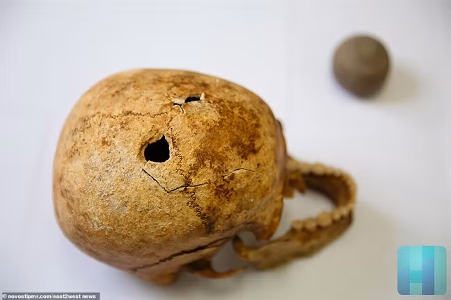 Một vài người may mắn sống sót sau ca phẫu thuật nhưng gặp phải những biến chứng nguy hiểm như ảnh hưởng đến khả năng nhận thức.