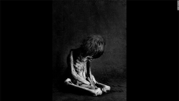 Xác ướp của đứa trẻ trong bức hình được xác nhận từng mắc bệnh lao. Do không được chữa trị tốt nên phần lưng và cột sống của cậu bé bị lệch.