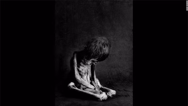 Xác ướp của đứa trẻ trong bức hình được xác nhận từng mắc bệnh lao. Do không được chữa trị tốt nên phần lưng và cột sống của cậu bé bị lệch.