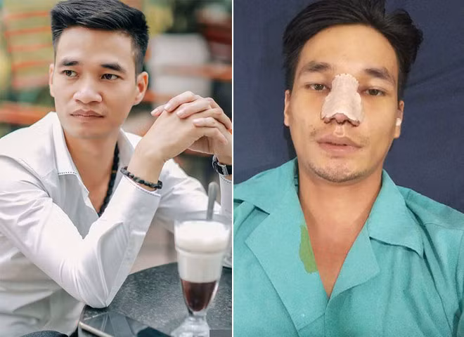 Vào giữa tháng 7 vừa qua, chàng trai gốc Hải Dương đã bất ngờ công khai quá trình phẫu thuật thẩm mỹ trên mạng xã hội.