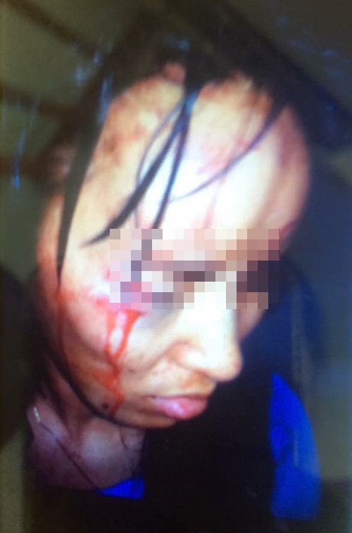 Những vết máu chảy trên đầu, mặt nạn nhân vì bị chồng hành hung.