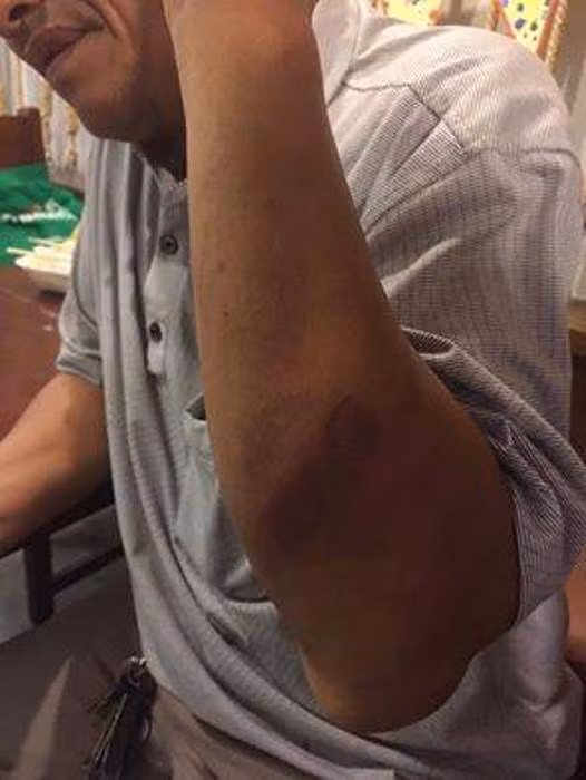 Vết thương trên tay ông Nghị sau khi bị tài xế taxi Vic hành hung.