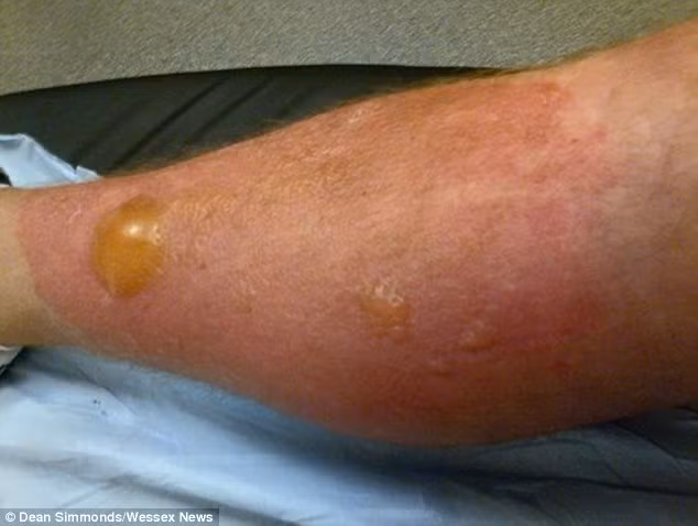 Ngò tây khổng lồ (giant hogweed) là một loài cây độc hại, chứa một loại chất độc bí ẩn. Nhựa cây trở thành chất độc khi tiếp xúc với ánh sáng mặt trời, gây kích ứng nghiêm trọng cho người, để lại sẹo vĩnh viễn và thậm chí có thể gây mù nếu tiếp xúc với mắt.