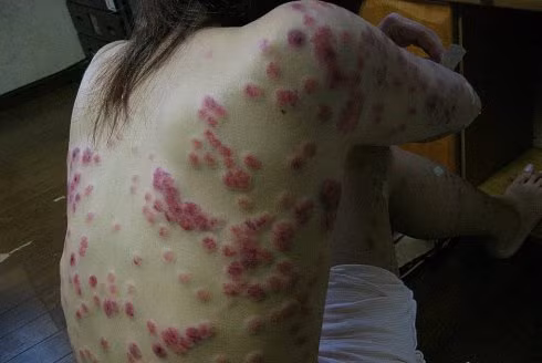 Hồng ban xuất hiện ở 2 bền sườn, cánh tay và vùng ngực, bụng. Sau giai đoạn về hồng ban sẽ xuất hiện các sẩn gồ ghề, người ta gọi là sẩn giang mai, nó có thể liên kết lại với nhau tạo thành các mảng, khi cọ xát vào sẽ dễ bị trầy, chảy dịch mủ,.. Thời kỳ này người bệnh cũng sẽ có những triệu chứng như đau họng, sốt, nổi hạch, đau đầu,…triệu chứng này sẽ mất đi sau 3-6 tuần.