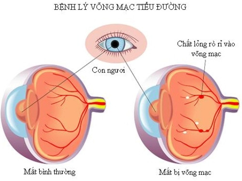 Tổn thương mắt. Người tiểu đường sẽ thường xuyên thấy có hiện tượng mắt đỏ do các mạch máu trong võng mạc bị vỡ, gây tổn thương mắt, biến chứng thành đục thủy tinh thể, tăng nhãn áp, mù lòa,…