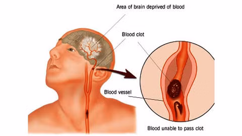 Bệnh lý mạch máu và tim. Đây là biến chứng thường gặp và cực kỳ nguy hiểm ở người bệnh tiểu đường. Khi lượng đường cao gây nên biến chứng xơ cứng động mạch, tai biến mạch máu não, nhồi máu cơ tim, gây tử vong cao.Theo thống kê của Bộ y tế có tới 65% người mắc bệnh tiểu đường tử vong do tai biến mạch máu não.