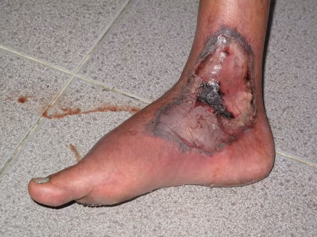 Nhiễm trùng. Nhiễm trùng răng, lợi, thận, bàng quang, chân, tay, tăng mụn nhọt và nhiễm nấm…là biến chứng mà bệnh tiểu đường rất dễ gây ra cho bạn. Để ngăn chặn tình trạng này bạn cần phải có biện pháp hạ và kiểm soát lượng đường trong máu.