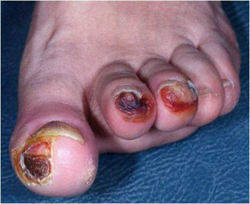 Năm 2013 trên toàn thế giới đã có 5,1 triệu người tử vong do tiểu đường, trong đó có tới 1,9 triệu người thuộc khu vực Tây Thái Bình Dương. Tại Việt Nam mỗi ngày có tới 150 ca tử vong do tiểu đường, tương đương với 54,943 trường hợp/năm.