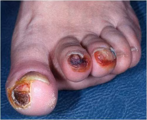 Năm 2013 trên toàn thế giới đã có 5,1 triệu người tử vong do tiểu đường, trong đó có tới 1,9 triệu người thuộc khu vực Tây Thái Bình Dương. Tại Việt Nam mỗi ngày có tới 150 ca tử vong do tiểu đường, tương đương với 54,943 trường hợp/năm.