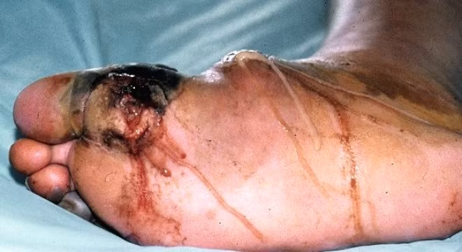 Theo thống kê của Bộ y tế, trong khoảng 10 năm trở lại đây tỷ lệ đái tháo đường ở nước ta tăng với mức chóng mặt (211%). Với tỷ lệ này thì hiện Việt Nam đang là một trong số các quốc gia có tỷ lệ mắc tiểu đường cao nhất trên thế giới. Hiện cả nước có tới 5 triệu người mắc căn bệnh này. 