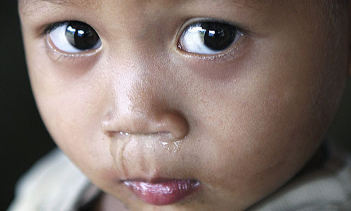 Đa số các trường hợp này không phải do nhiễm khuẩn mà do một số loại virus, do vậy dùng thuốc trong trường hợp này không có tác dụng. Cha mẹ không cần phải đưa con tới gặp bác sĩ hay cho con sử dụng bất kỳ loại thuốc nào. Ảnh minh họa: Internet.