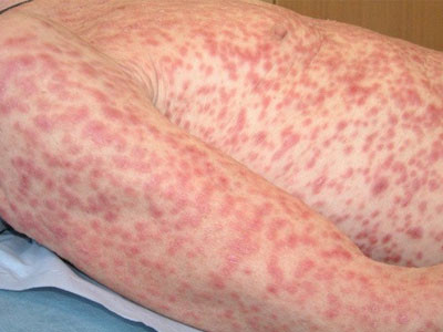 Thời kỳ II. Sau khoảng 4-10 tuần biến mất, săng giang mai lại xuất hiện trở lại với triệu chứng mờ nhạt hơn vì nó xuất hiện ẩn dưới da với màu hồng đào hay đậm hơn người ta gọi đó là hồng ban. Khi ấn vào các nốt hồng ban thì nó sẽ biến mất.