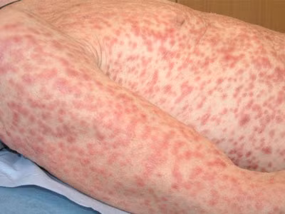 Thời kỳ II. Sau khoảng 4-10 tuần biến mất, săng giang mai lại xuất hiện trở lại với triệu chứng mờ nhạt hơn vì nó xuất hiện ẩn dưới da với màu hồng đào hay đậm hơn người ta gọi đó là hồng ban. Khi ấn vào các nốt hồng ban thì nó sẽ biến mất.