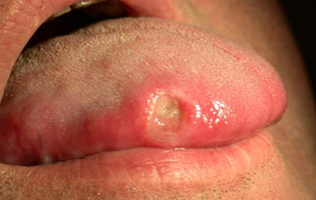 Săng thường xuất hiện ở bộ phận sinh dục, bàn tay và bàn chân của người bệnh. Sau xuất hiện từ 3-6 tuần các săng sẽ tự mất đi khiến người bệnh tưởng lầm rằng đã khỏi. Giang mai ở miệng lây do quan hệ tình dục bằng miệng, đường hôn.