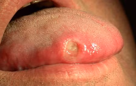 Săng thường xuất hiện ở bộ phận sinh dục, bàn tay và bàn chân của người bệnh. Sau xuất hiện từ 3-6 tuần các săng sẽ tự mất đi khiến người bệnh tưởng lầm rằng đã khỏi. Giang mai ở miệng lây do quan hệ tình dục bằng miệng, đường hôn.