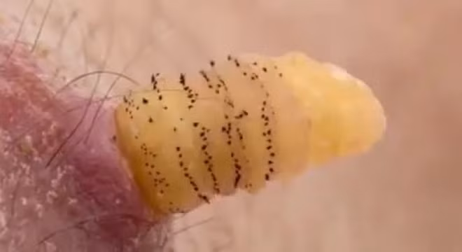 Sau khi đi kiểm tra y tế, các bác sỹ phát hiện giòi xâm nhập đầy não và ổ trứng giòi nằm trên mối nối tóc. Sau đó, cô Irene đã phải cạo trọc đầu và điều trị kháng sinh để giệt lũ giòi trong não bộ.