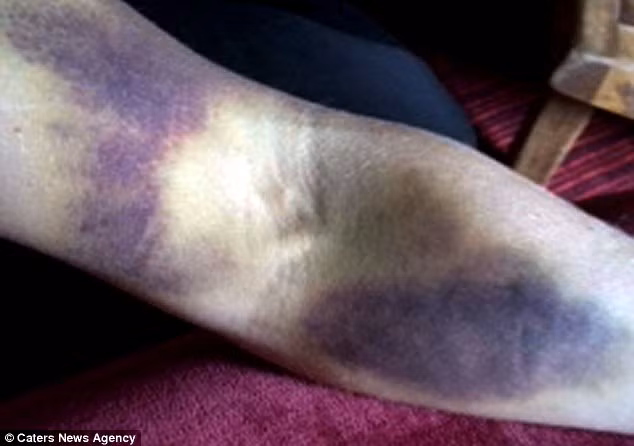 Bệnh ung thư hiếm này có tên Promyelocytic bạch cầu (APML) chỉ chiếm 10-15% các bệnh máu trắng. Các tế bào myelocytic trong cơ thể đảm nhiệm chức năng như chống nhiễm trùng, bảo vệ cơ thể chống lại ký sinh trùng và ngăn ngừa lây lan tổn thương mô.