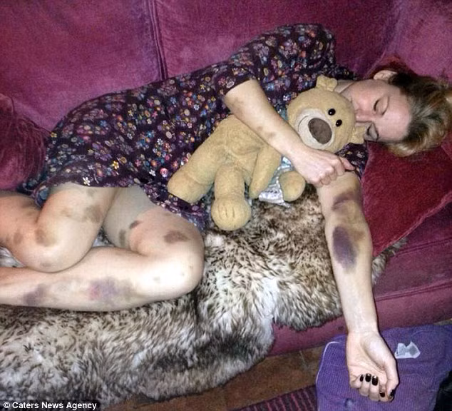 Sau vài ngày vết thâm không hề tan, cô đã đến gặp bác sỹ gia đình và ông ấy chẩn đoán Wilson bị rối loạn tiêu hóa. May mắn là, bác sỹ gia đình không chắc chắn nên đã khuyên cô đến bệnh viện bệnh viện Hoàng gia Shrewsbury để xét nghiệm tủy xương.