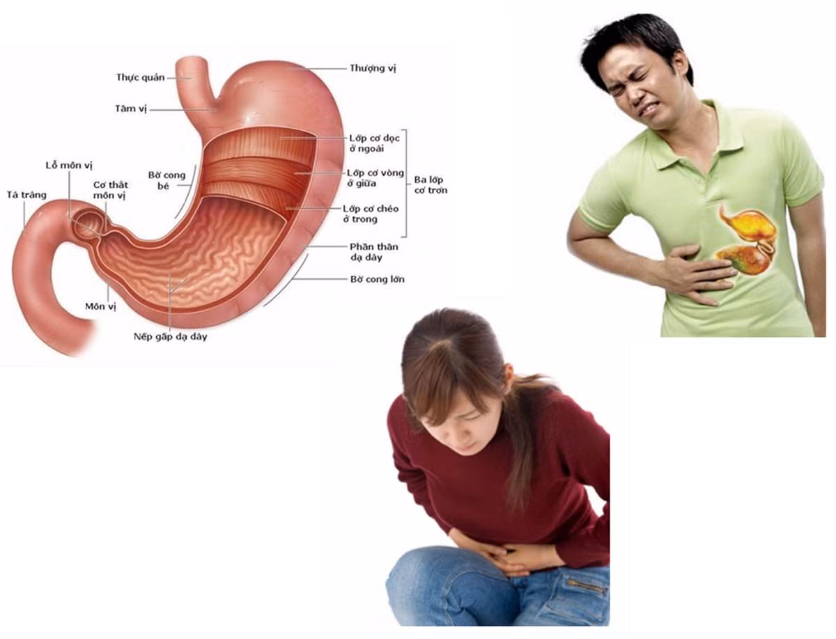 Theo Livestrong, bia có thể kích thích viêm loét dạ dày bằng cách tạo ra axit hydrochioric và pepsin, gây chướng bụng trên, khiến bạn buồn nôn hoặc nôn không kiểm soát và đau bụng dữ dội.
