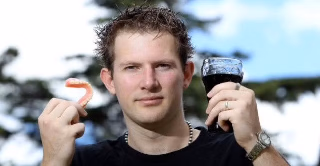 Nam thanh niên 25 tuổi này phải đeo răng giả vì uống Coca-cola. Ảnh: sante-nutrition.org.