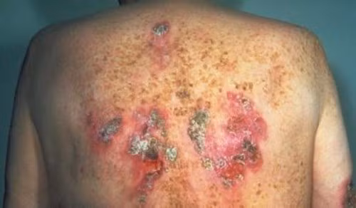 Biến chứng giang mai. Giang mai tim mạch (chiếm 10%). Diễn ra từ 10-30 năm mắc bệnh, người bệnh thường gặp biến chứng phình mạch.