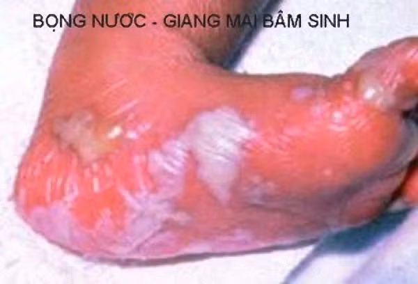 Trường hợp trẻ bị xâm hại tình dục hay chung sống với bố mẹ mắc giang mai cũng có thể bị nhiễm bệnh từ người lớn thông qua tiếp xúc với dịch mủ của người bệnh trên bề mặt da hay đường hôn.