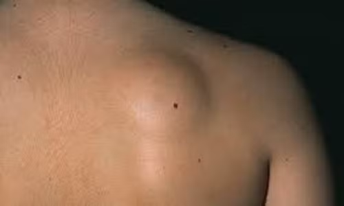 Xuất hiện các mô mỡ. Một số người bị ung thư tuyến tụy xuất hiện những mô mỡ dưới da không đồng đều. Điều này là do việc phát hành các enzyme tiêu hóa chất béo tụy tràn ra dưới da.