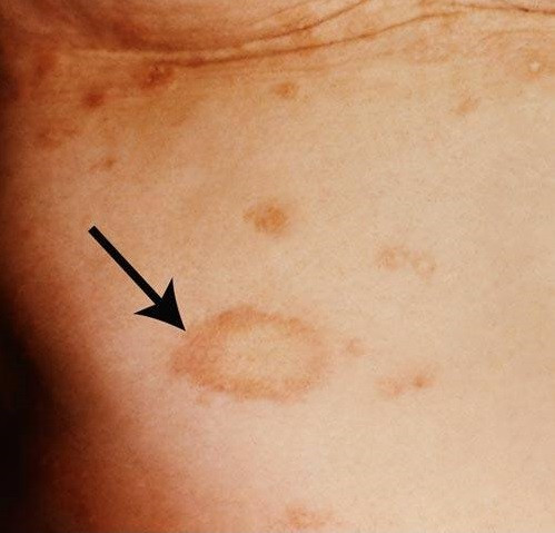 Thời kỳ I. Đây là thời kỳ ủ bệnh, thường kéo dài trong khoảng 3 tuần. Sau 3 tuần nhiễm Treponema pallidum trên cơ thể người bệnh bắt đầu nổi các nốt, ban đỏ hình ô van hay bầu dục có viền màu đỏ. 