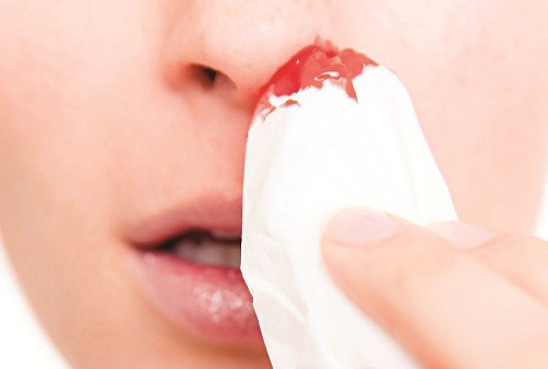 Chảy máu cam. Đây là hiện tượng khá phổ biến. Tuy nhiên, nếu lượng máu chảy nhiều, xảy ra liên tục trong nhiều ngày thì nên đi khám sớm. Bởi đây có thể là hệ quả của việc giảm số lượng tiểu cầu - tế bào có tác dụng cầm máu. Ảnh: zing
