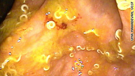 Mỗi khi ruột có dấu hiệu xuất huyết, anh lại lấy ấu trùng giòi từ chất thải của chính cơ thể mình, làm sạch, nuôi lớn và nuốt chúng vào bụng. Chúng như một tiên dược giúp cho cơ thể bệnh nhân khỏe lại nhưng thay vào đó là sự hiện diện của rất nhiều dòi bọ trong ruột.