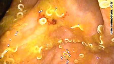 Mỗi khi ruột có dấu hiệu xuất huyết, anh lại lấy ấu trùng giòi từ chất thải của chính cơ thể mình, làm sạch, nuôi lớn và nuốt chúng vào bụng. Chúng như một tiên dược giúp cho cơ thể bệnh nhân khỏe lại nhưng thay vào đó là sự hiện diện của rất nhiều dòi bọ trong ruột.