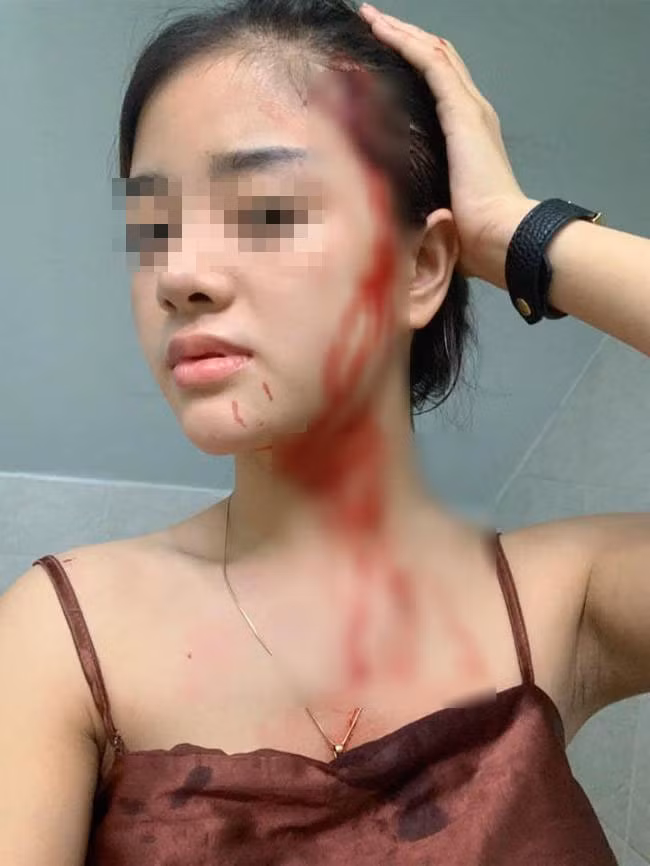 Bạn bè thân Hoàng Hải Yến cho biết, Yến vừa bị chồng đánh chảy máu đầu tại TP HCM. Đây không phải lần đầu tiên anh ta thượng cẳng tay, hạ cẳng chân với vợ xinh như hoa.