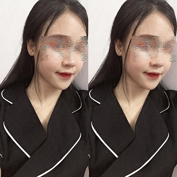 Sau khi bị chồng đánh, vết thương của cô gái khá nghiêm trọng. Tai chảy máu, môi bầm dập và tay chân có nhiều chỗ xước xát. Rất nhanh ngay sau đó, dân mạng đã truy tìm được Facebook của cô gái bất hạnh này. Được biết, cô gái có tên là P.M.Y, sống tại Hà Nội.