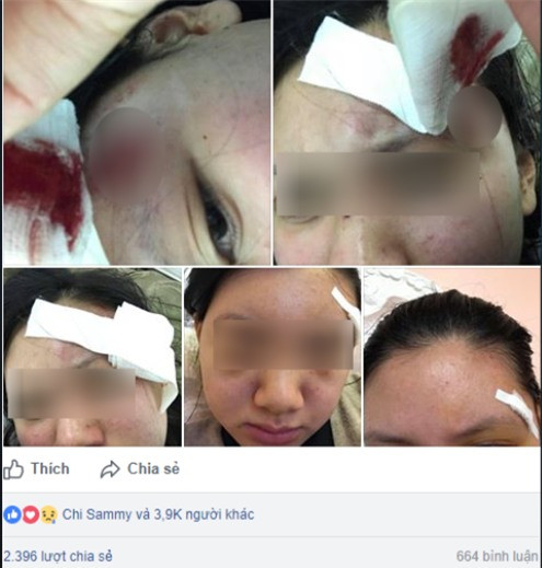  4. Người vợ xinh đẹp “tố” bị chồng đánh rách đầu, mang bầu cũng hành hung, ngày 17/12/2017. Chị Trương Khánh V. ( trú tại phường Thanh Lương, quận Hai Bà Trưng, Hà Nội) đã bị chồng đánh nhập viện.