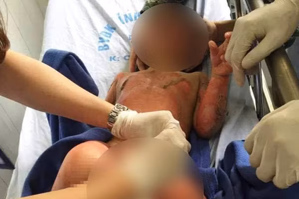 2 be bi bong nang vu co giao dung con day PCCC da duoc ghep da