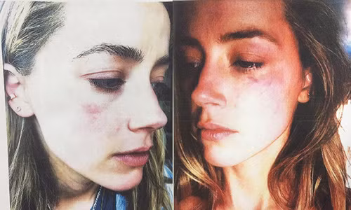 Amber Heard đã trưng lên tòa những hình ảnh được cho là bằng chứng cô bị chồng đánh bầm tím mặt. (Ảnh: Internet)
