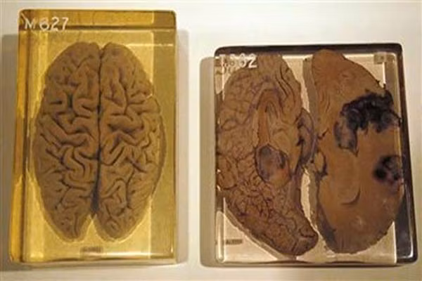 Bảy giờ sau khi ông từ trần, chuyên gia bệnh học – tiến sĩ Thomas Harvey đã cắt não của ông thành 240 khối để nghiên cứu dưới kính hiển vi để xem điều gì khiến Einstein xuất chúng như vậy. Tuy nhiên, trái với sự mong đợi, não của ông giống như bất cứ ai, thậm chí một số tế bào không mấy ấn tượng. Sau đó, bộ não của thiên tài biến mất. Mãi cho tới năm 1978, bộ não của Einstein mới được tìm thấy trở lại.