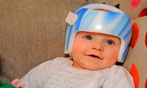 Freddie Summersgill bị chẩn đoán mắc chứng đầu phẳng khi 6 tháng tuổi