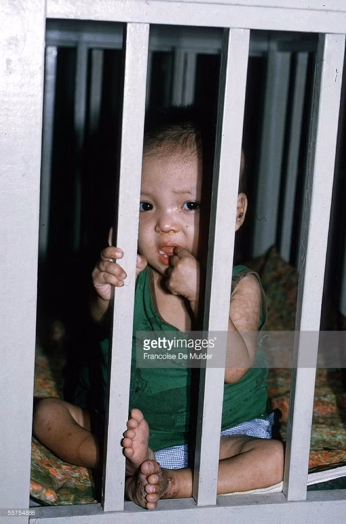 Một em bé bị di tật do di chứng chất độc da cam thời chiến tranh Việt Nam được nuôi dưỡng tại một cơ sở ở TP HCM.