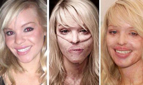 Gần đây trong xã hội hay xuất hiện hình thức tấn công người bằng cách tạt axit khiến nạn nhân, đa số là phụ nữ và trẻ em, bị bất ngờ, không né tránh kịp thời, dẫn đến bỏng nặng, thương tật vĩnh viễn và hủy hoại nhan sắc. Bởi vậy, việc xử lý thông minh nhất khi bị dính axit hay bỏng hóa chất trước khi được cấp cứu ở bệnh viện sẽ giảm đau đớn rất nhiều.